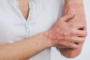 psoriasis g076788fa7 1920